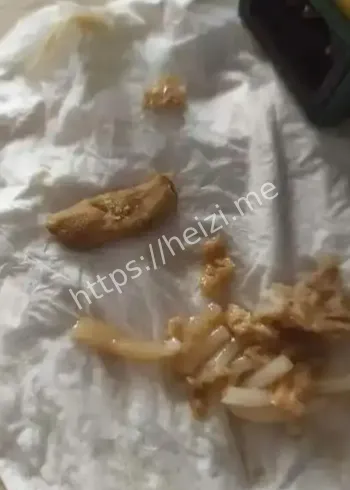 臭宝螺蛳粉异物风波